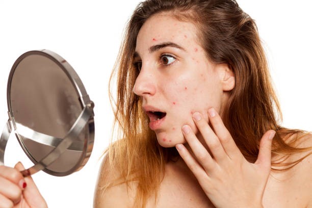 Budget Friendly Acne Solutions