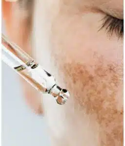 close-up of serum dropper applying treatment on skin with melasma and dark spots