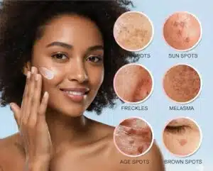 Smiling woman applying skincare cream with visual guide showing six types of skin pigmentation including dark spots, sun spots, freckles, melasma, age spots, and brown spots